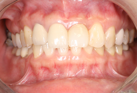 治療後（After）