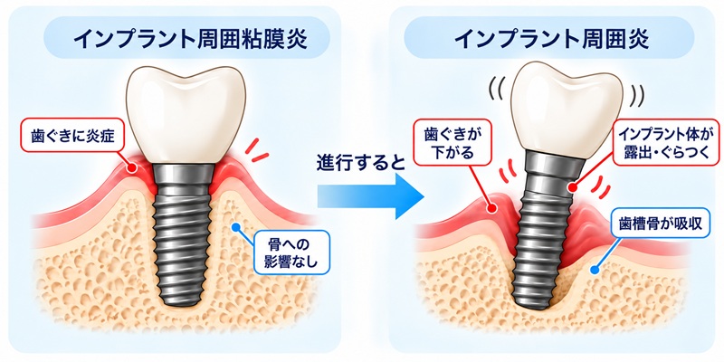 インプラント周囲粘膜炎とインプラント歯周炎の図解