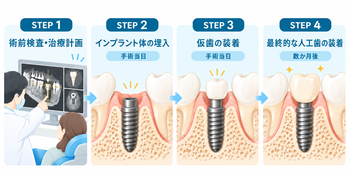 1Dayインプラントの流れ(工程)の図解